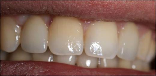 Implants with Zirconium abutments