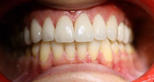 Porcelain veneers