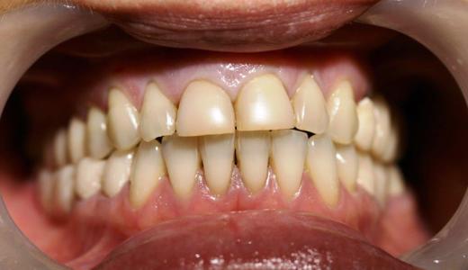 Porcelain veneers