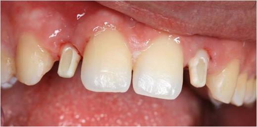 Implants with Zirconium abutments